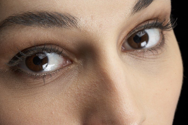 lines under eyes at 18