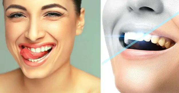 How to whiten bonded teeth at home