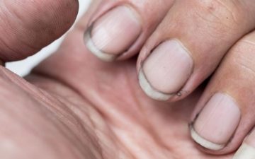 Dirty nails