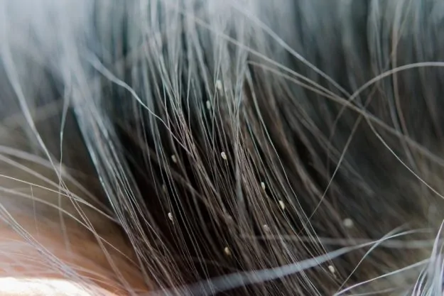 will hair dye kill lice